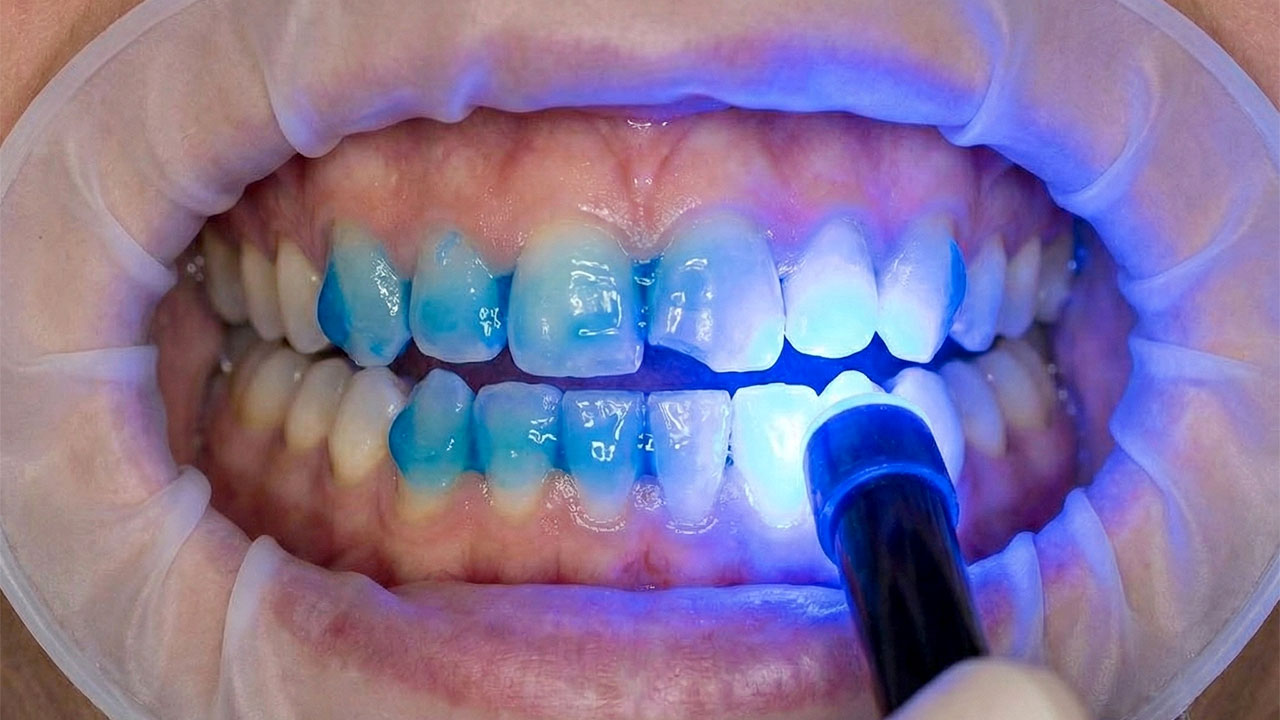 Combination-Treatments-Dental Bonding Services