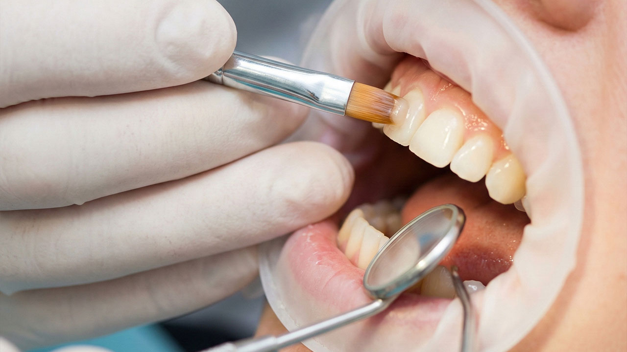 Cosmetic Bonding - Dental Bonding Services