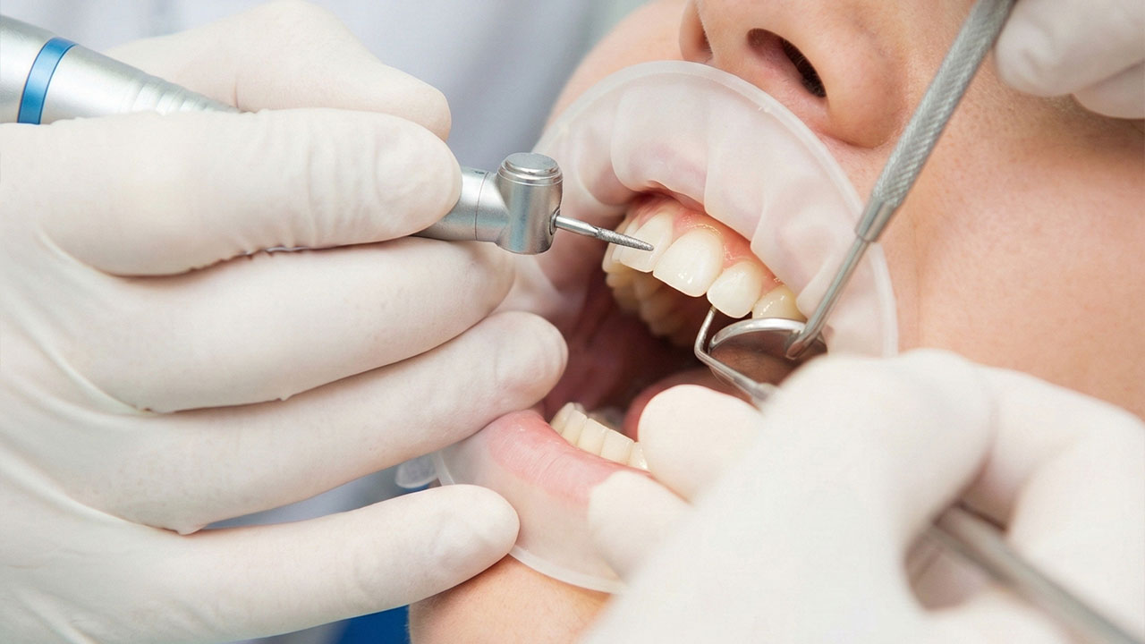Repair After Trauma - Dental Bonding Services