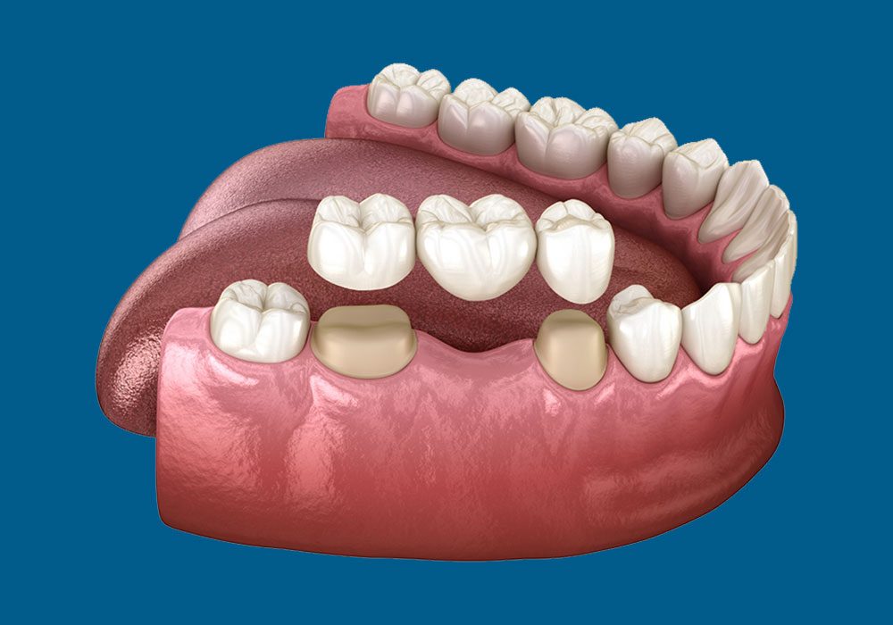 How Long Do Dental Crowns Last - Dentist for Chickens