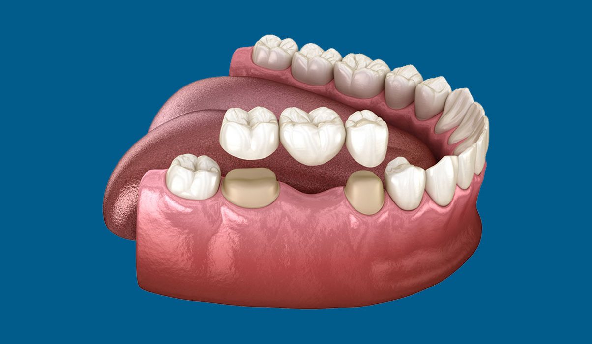 How Long Do Dental Crowns Last - Dentist for Chickens