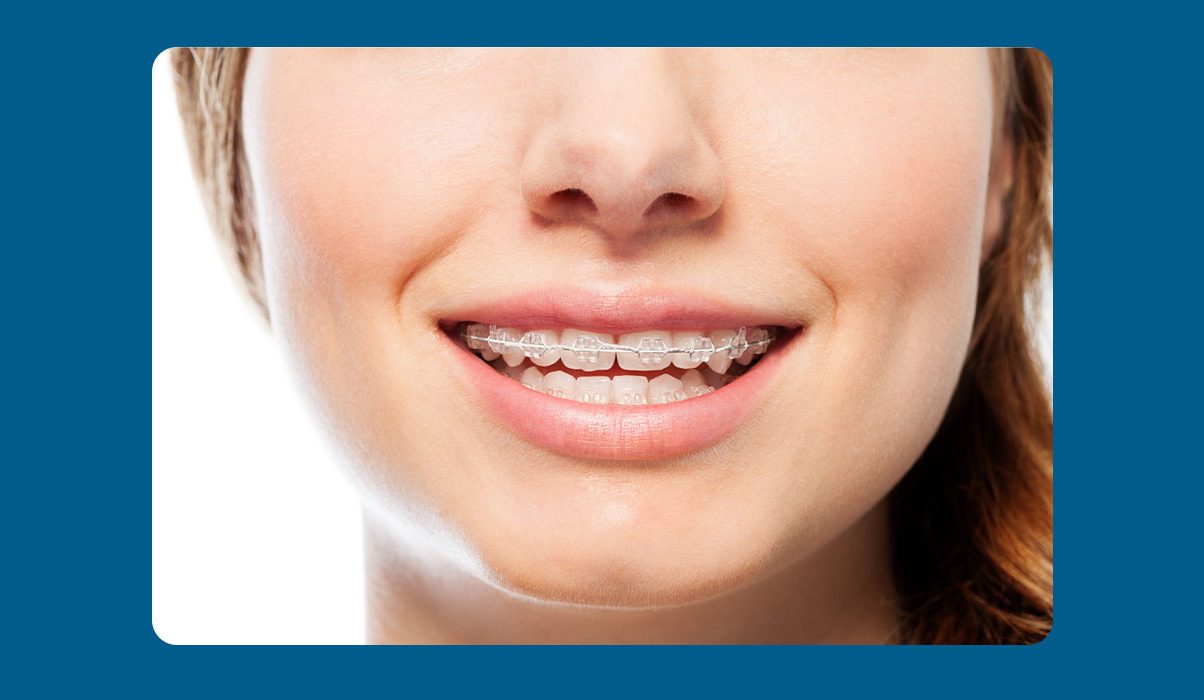 When Is the Right Time for Braces